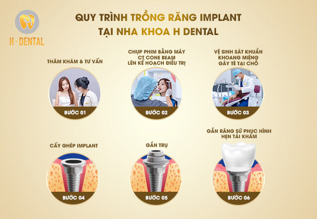 Quy trình trồng răng Implant tại nha khoa H Dental