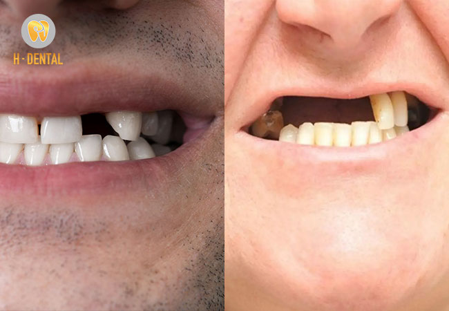 Trồng răng Implant là kỹ thuật tối ưu nhất đối với tình trạng mất răng