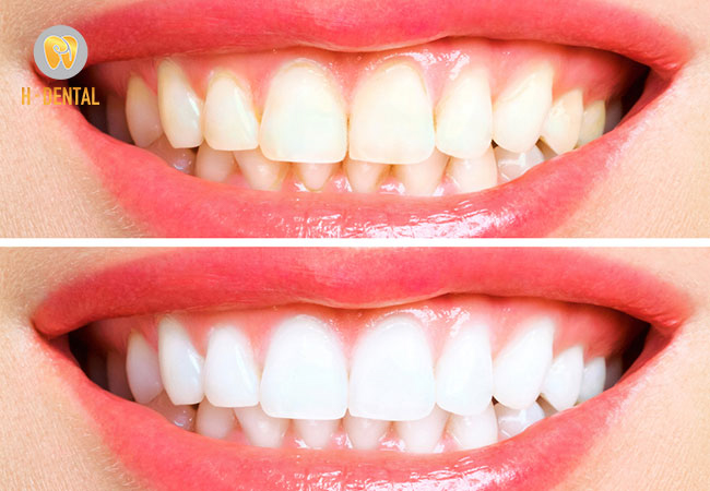 Kết quả trước và sau khi điều trị trám răng