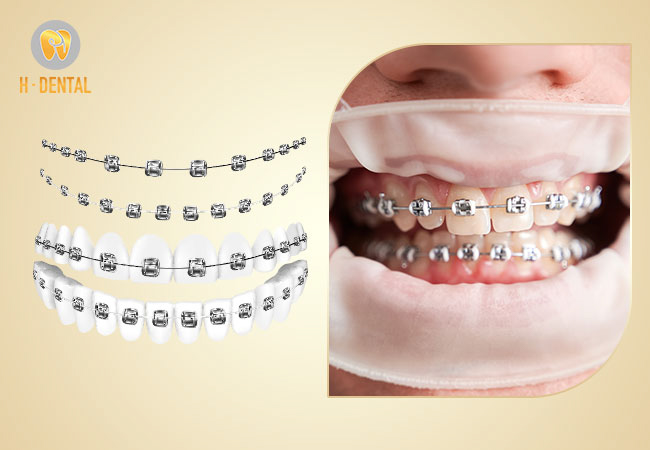 Niềng răng có công dụng điều chỉnh răng mọc lệch, răng thưa, răng hô, móm