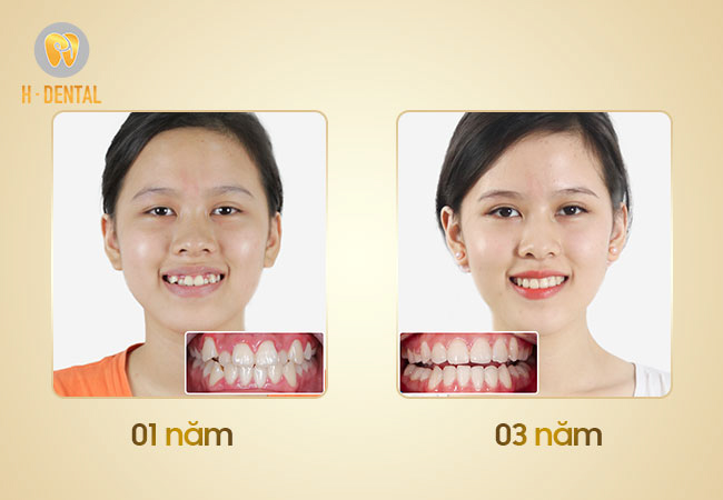 Thời gian niềng răng kéo dài từ 1 đến 3 năm tùy tình trạng răng