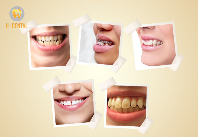 Tình trạng răng là một trong các yếu tố quyết định chi phí niềng răng