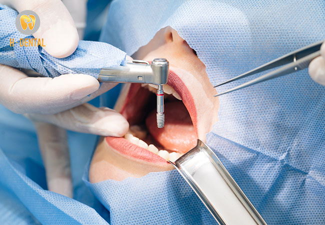 Trồng răng Implant giúp phục hình thân răng bị mất hiệu quả