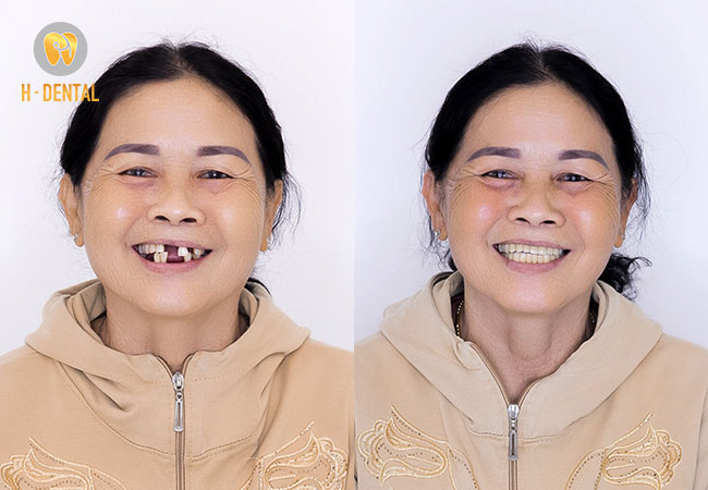 Giá trồng răng Implant dao động từ 10.000.000 đồng đến 45.000.000 đồng