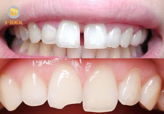 Răng thưa, răng sứt mẻ có thể đi trám răng để khắc phục