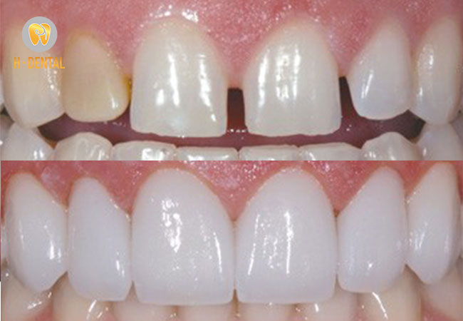 Trám răng nhằm khắc phục vấn đề răng sứt mẻ nhẹ rất hiệu quả