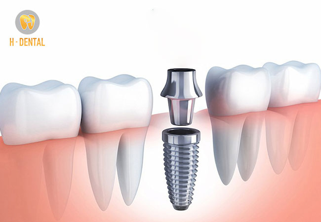 Công đoạn cắm trụ Implant vào hàm