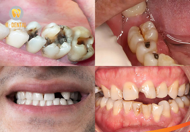 Một số trường hợp phổ biến nên đi chữa tủy răng
