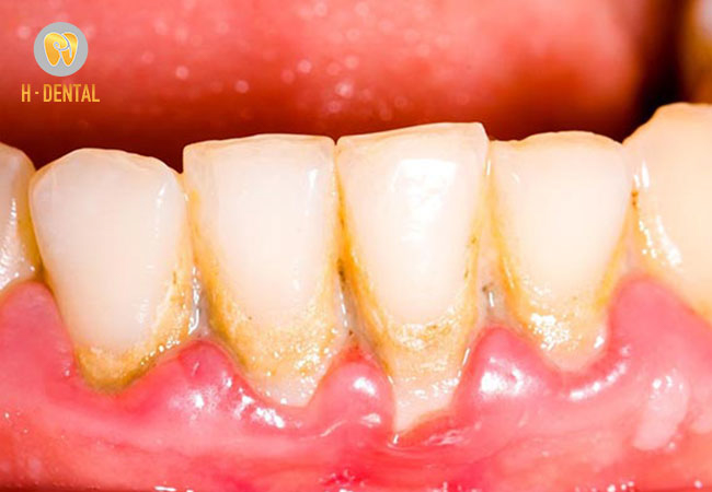 Mảng bám ở vùng chân răng và kẻ răng là dấu hiệu bệnh viêm nha chu