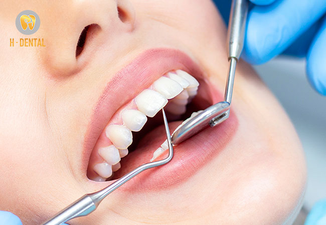 Dịch vụ cạo vôi răng tại H Dental có giá từ 300.000 - 500.000 đồng