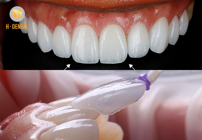 Dán răng sứ veneer thẩm mỹ răng không gây đau nhức