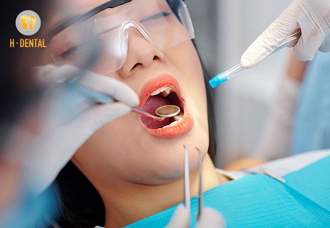 Chi phí cắt lợi tại nha khoa H Dental mới nhất