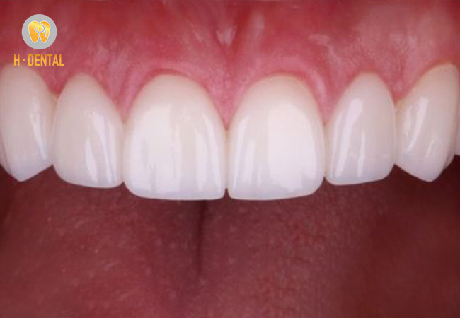 Chi phí bọc răng sứ trọn gói có thể thay đổi do nhiều yếu tố