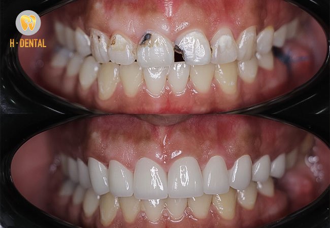 Tình trạng răng mẻ, vỡ và kết quả sau khi bọc răng sứ