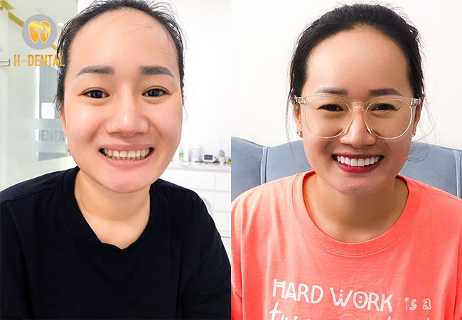 Kết quả của khách hàng trước và sau khi bọc răng sứ tại H Dental