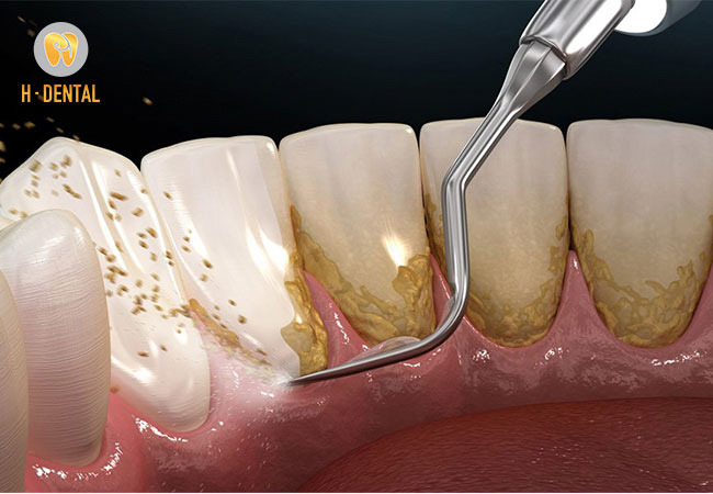 H Dental cạo vôi răng an toàn và hiệu quả lâu dài