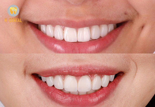 Cạo vôi răng cải thiện thẩm mỹ toàn bộ cho hàm răng và cả khuôn mặt