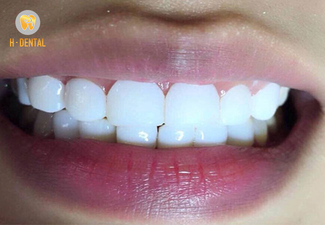 Bọc răng sứ có nhiều mức giá đáp ứng nhiều nhu cầu khách hàng