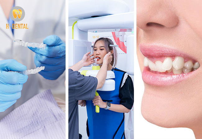 Trình tự các bước thực hiện niềng răng tại nha khoa H Dental