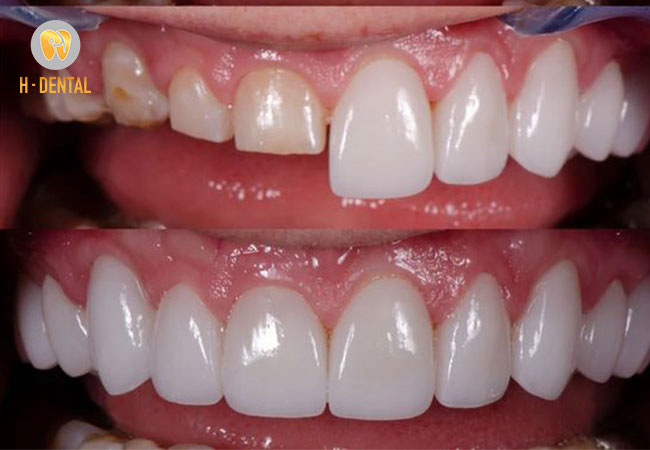 Dán sứ veneer có thể khắc phục nhiều khuyết điểm của răng