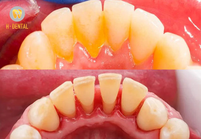 Các bác sĩ khuyên nên đi lấy vôi răng từ 3-6 tháng 1 lần
