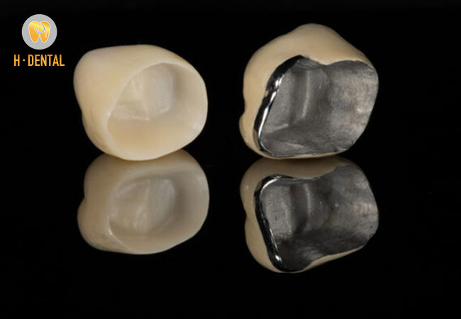 Giá răng sứ kim loại chỉ từ 1,2 triệu đến 2,5 triệu / răng