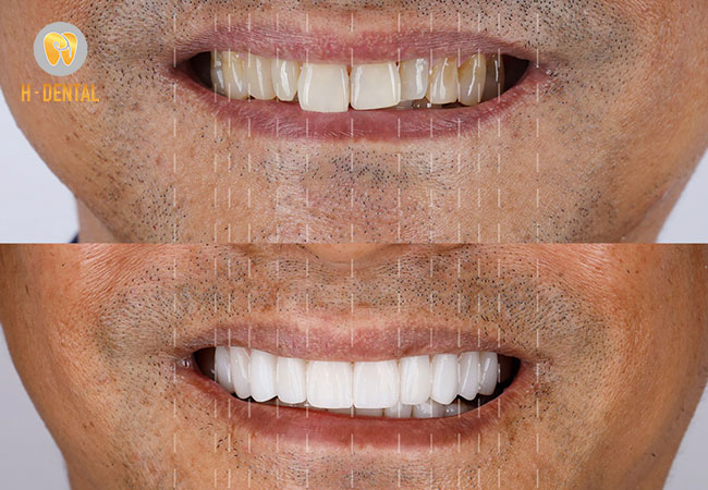 Bọc răng sứ mang lại hàm răng trắng sàng và đều đẹp tự nhiên