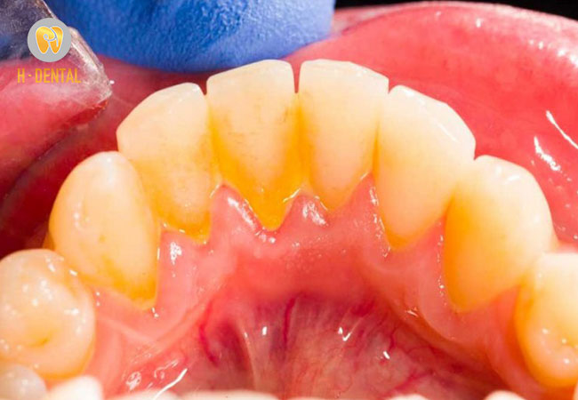 Hình ảnh vôi răng bám xung quanh chân và kẻ răng của bệnh nhân