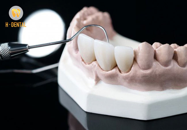 Răng toàn sứ có giá từ 4 triệu đến 9 triệu / răng