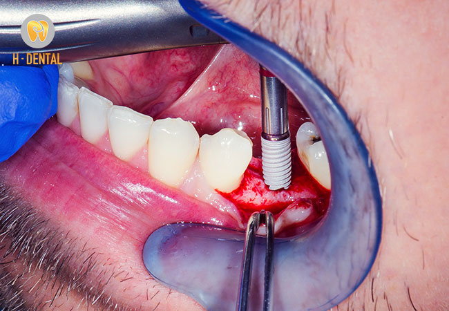 Nhổ răng rồi cắm Implant trong thời gian ngắn là giải pháp hữu hiệu