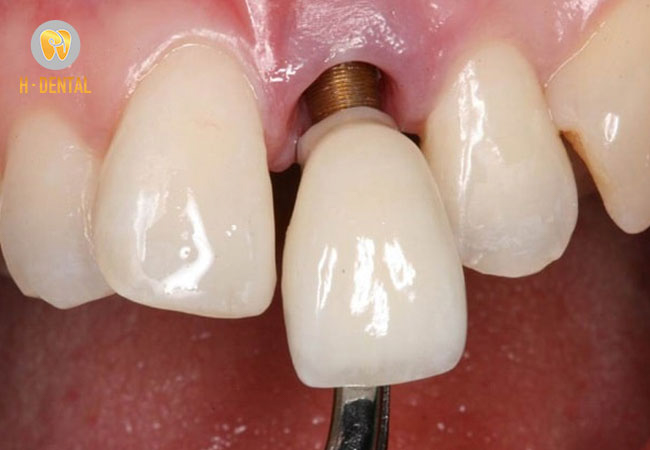 Thao tác phẫu thuật không chính xác sẽ làm răng bị lệch lạc