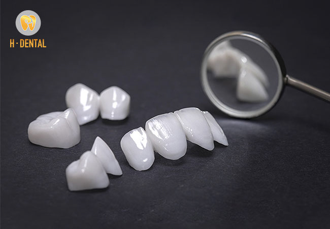 Chi phí của một răng sứ có mặt dán veneer là khoảng 7 triệu đồng / răng 