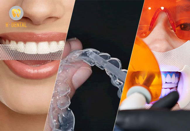 Các phương pháp tẩy trắng răng phổ biến hiện nay
