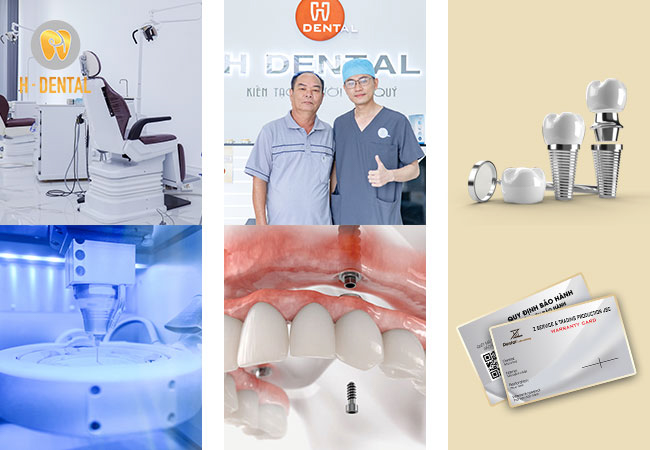 Phục hình răng Implant all on 4 an toàn và giá tốt tại H Dental