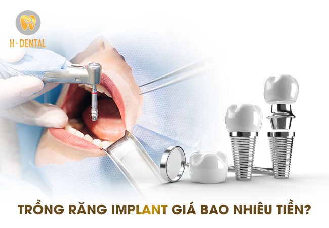 Trồng răng Implant giá bao nhiêu tùy thuộc vào rất nhiều yếu tố