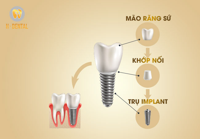 Trụ Implant có kết cấu 3 phần