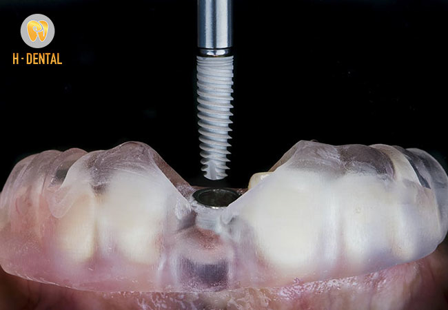 Chi phí dịch vụ trồng răng Implant all on 6 chỉ từ 100 triệu đồng