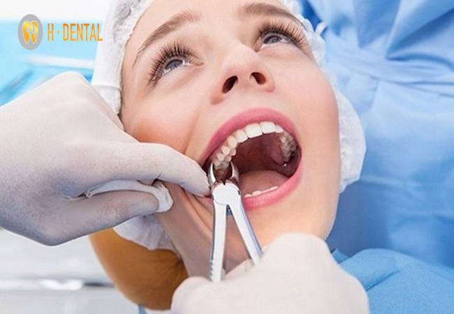 Một trong các giai đoạn đau nhất khi niềng răng là nhổ răng