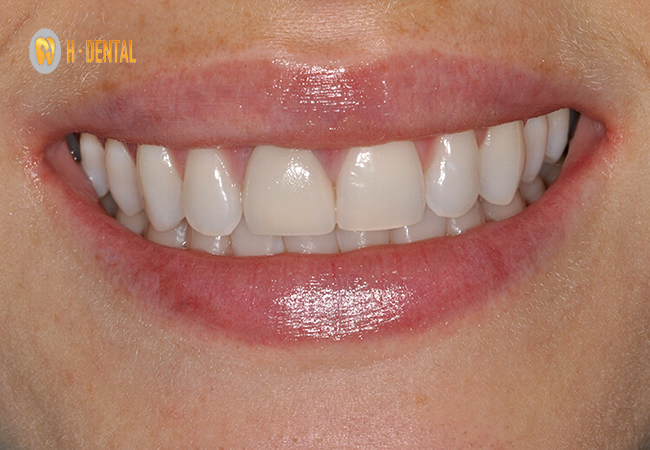 Răng bọc sứ bị đau kéo dài thường là do nền răng yếu, dễ tổn thương