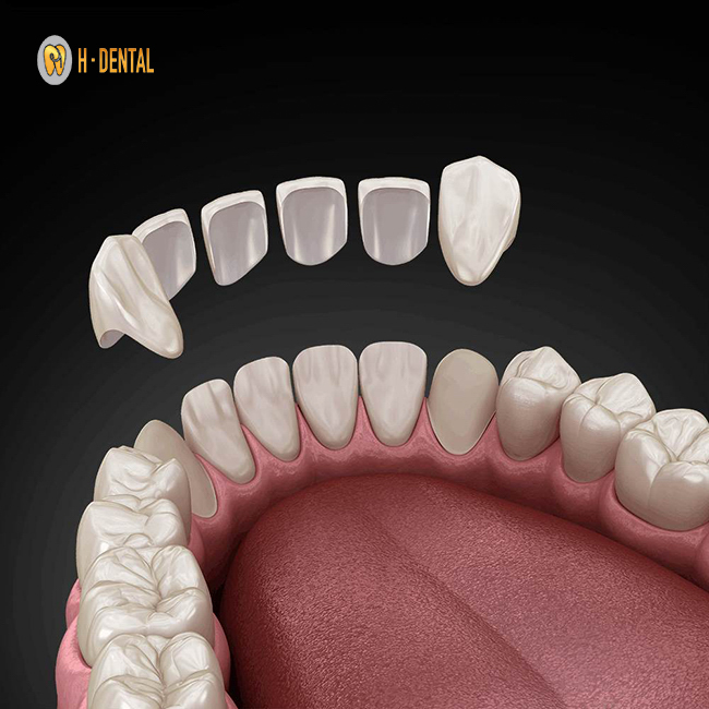 Răng sứ không đúng kích cỡ, lệch lạc cũng là một nguyên nhân phổ biến