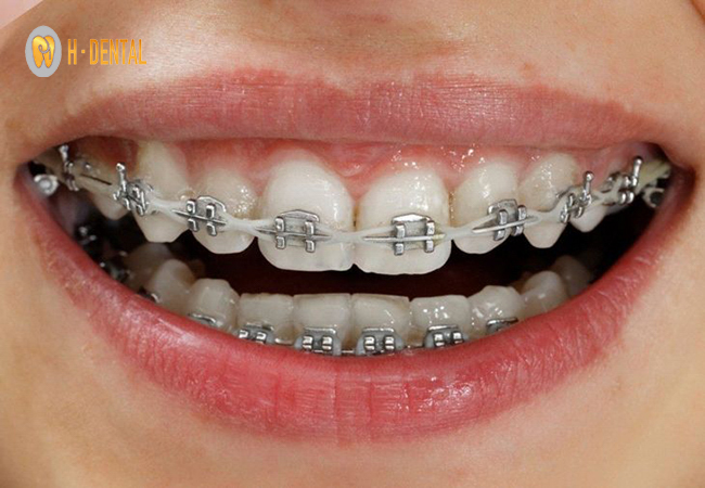 Mắc cài kim loại tự khóa có nhiều ưu điểm hơn so với các loại niềng răng khác