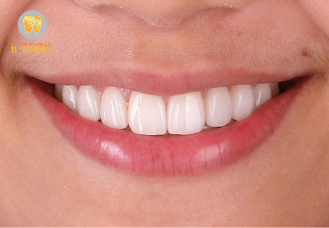 Cắt nướu mài xương ổ răng khắc phục triệt để tình trạng cười hở lợi, răng hô