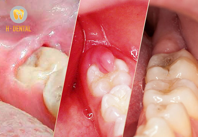 Dấu hiệu nhận biết tình trạng lợi trùm răng khôn