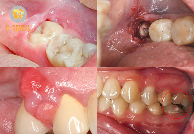 Một số biến chứng thường gặp của lợi trùm răng khôn