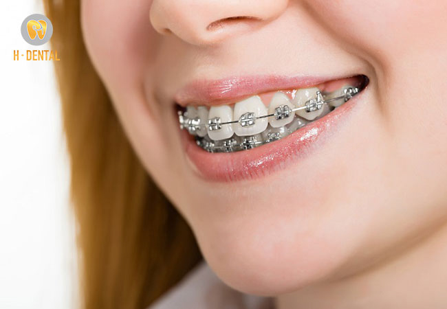 Giai đoạn 3-6 tháng tiếp nha sĩ sẽ điều chỉnh răng cho khít và đều