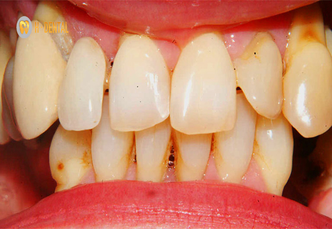 Có bầu trám răng được không cần đến nha khoa để bác sĩ thăm khám