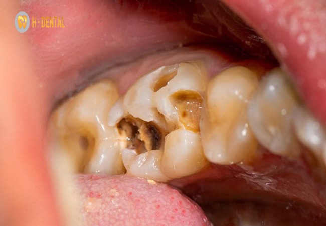 Răng số 7 bị viêm tủy có thể là do sâu, mẻ hoặc bị lây từ răng khác