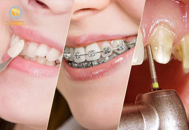 3 cách để khắc phục tình trạng răng hô nhẹ