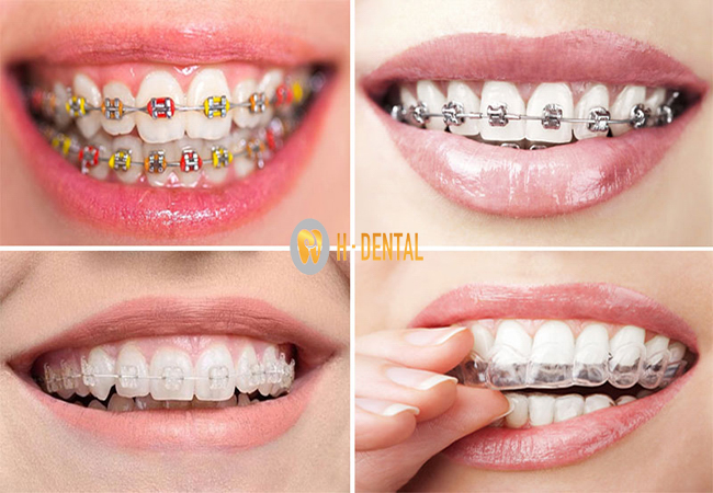 4 phương pháp niềng răng phổ biến nhất hiện nay