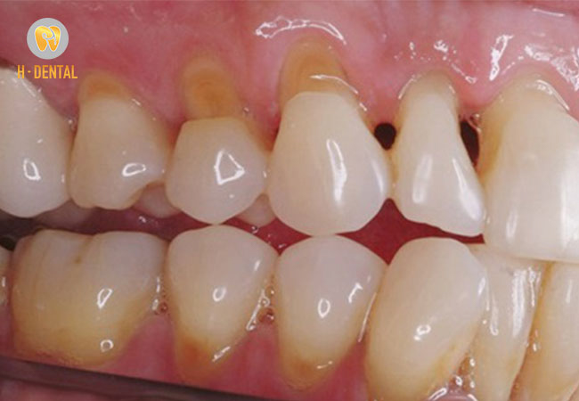 Tác hại của niềng răng có thể là gây tiêu chân răng